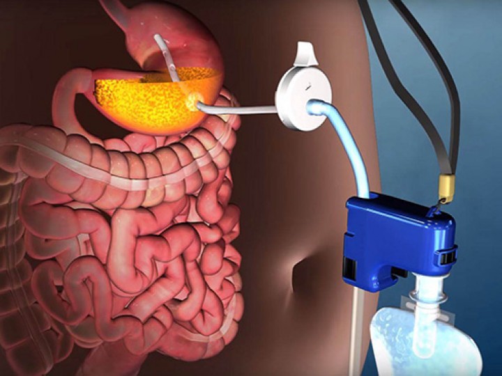 Dispositivo promete ajudar a perder peso sugando a comida diretamente do estômago
