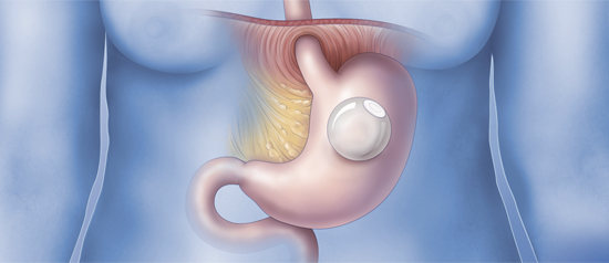 Balão gástrico agora também é alternativa para pessoas com sobrepeso